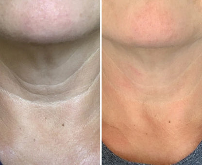 DermaLift™ - Advanced 3-minutes Neck Wrinkle Repair Trio