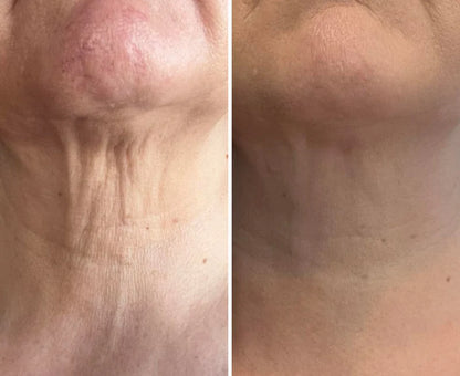DermaLift™ - Advanced 3-minutes Neck Wrinkle Repair Trio