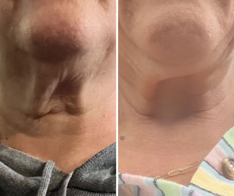 DermaLift™ - Advanced 3-minutes Neck Wrinkle Repair Trio
