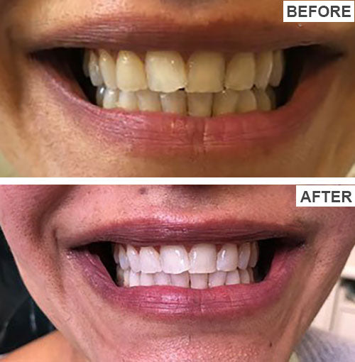 PalmWHITE™ - Teeth Brightening Powder Instant Brightening