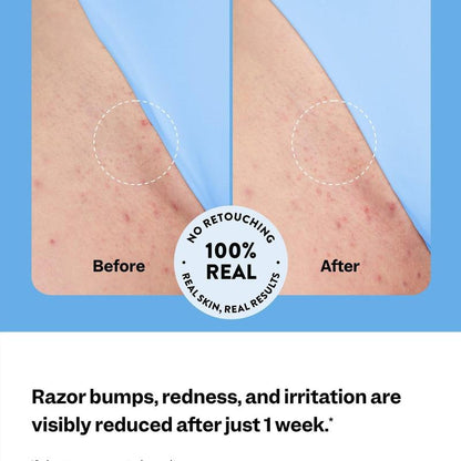 PeachSmooth™ – Roll-On Serum for Ingrown Hair & Razor Bumps