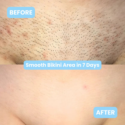 PeachSmooth™ – Roll-On Serum for Ingrown Hair & Razor Bumps