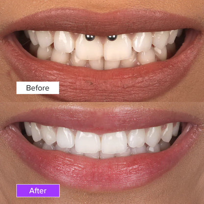 PalmWHITE™ - Teeth Brightening Powder Instant Brightening